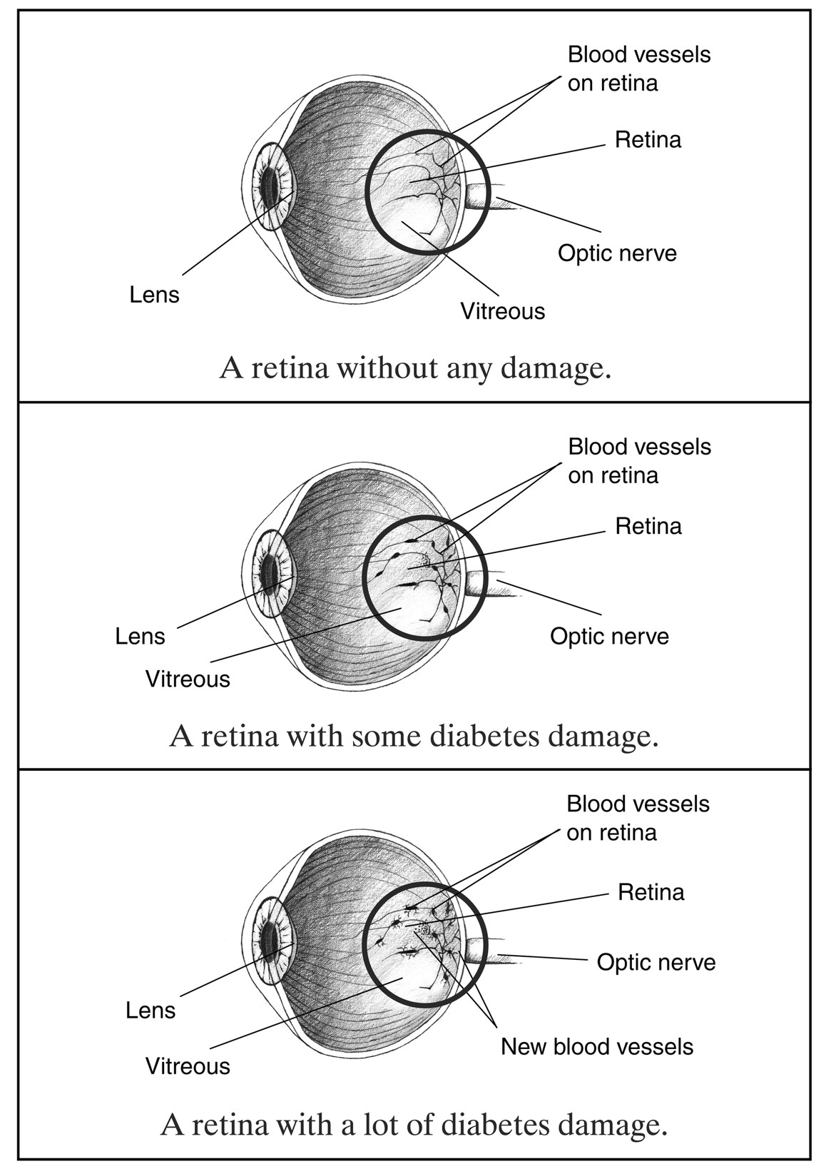 anatomical detail of diabetic retinopathy