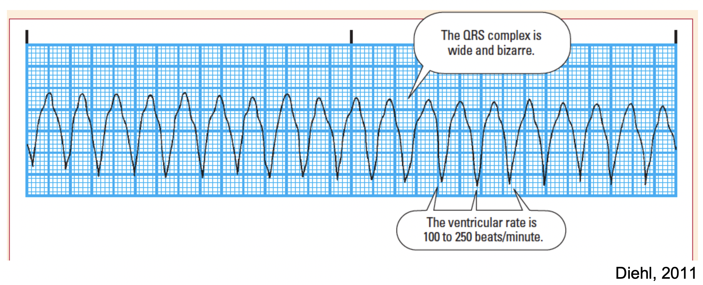 Introduction to Telemetry Monitoring for Arrhythmias Nursing CE Course