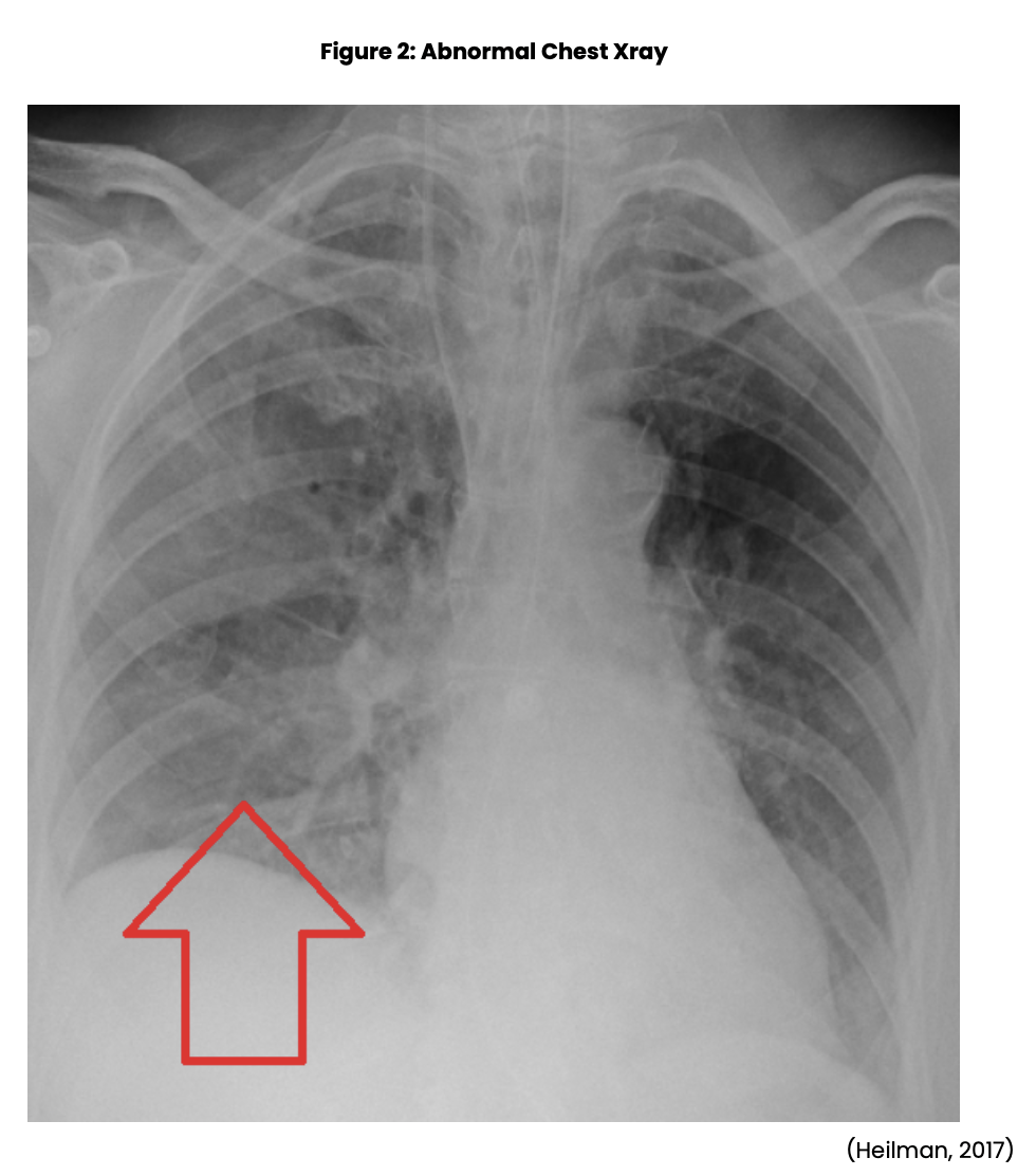 Postoperative Complications Nursing CE Course NursingCE