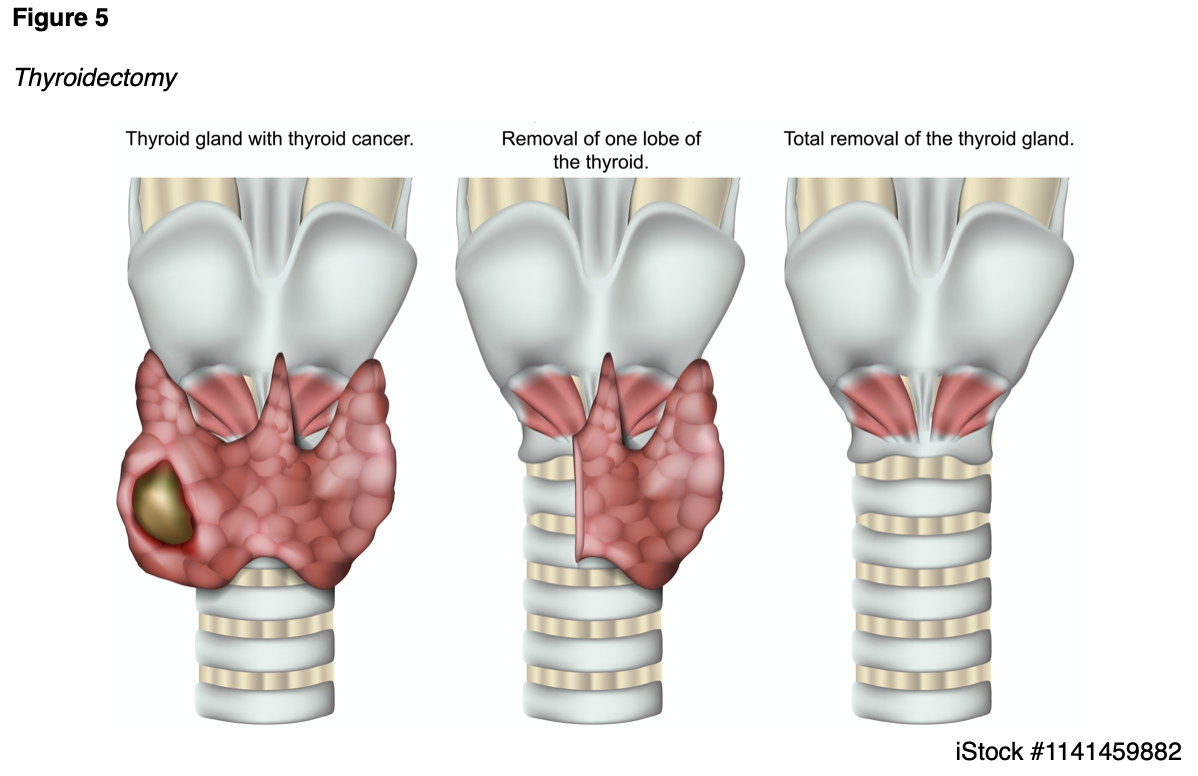 Thyroid Dysfunction for RNs and LPNs Nursing CE Course NursingCE