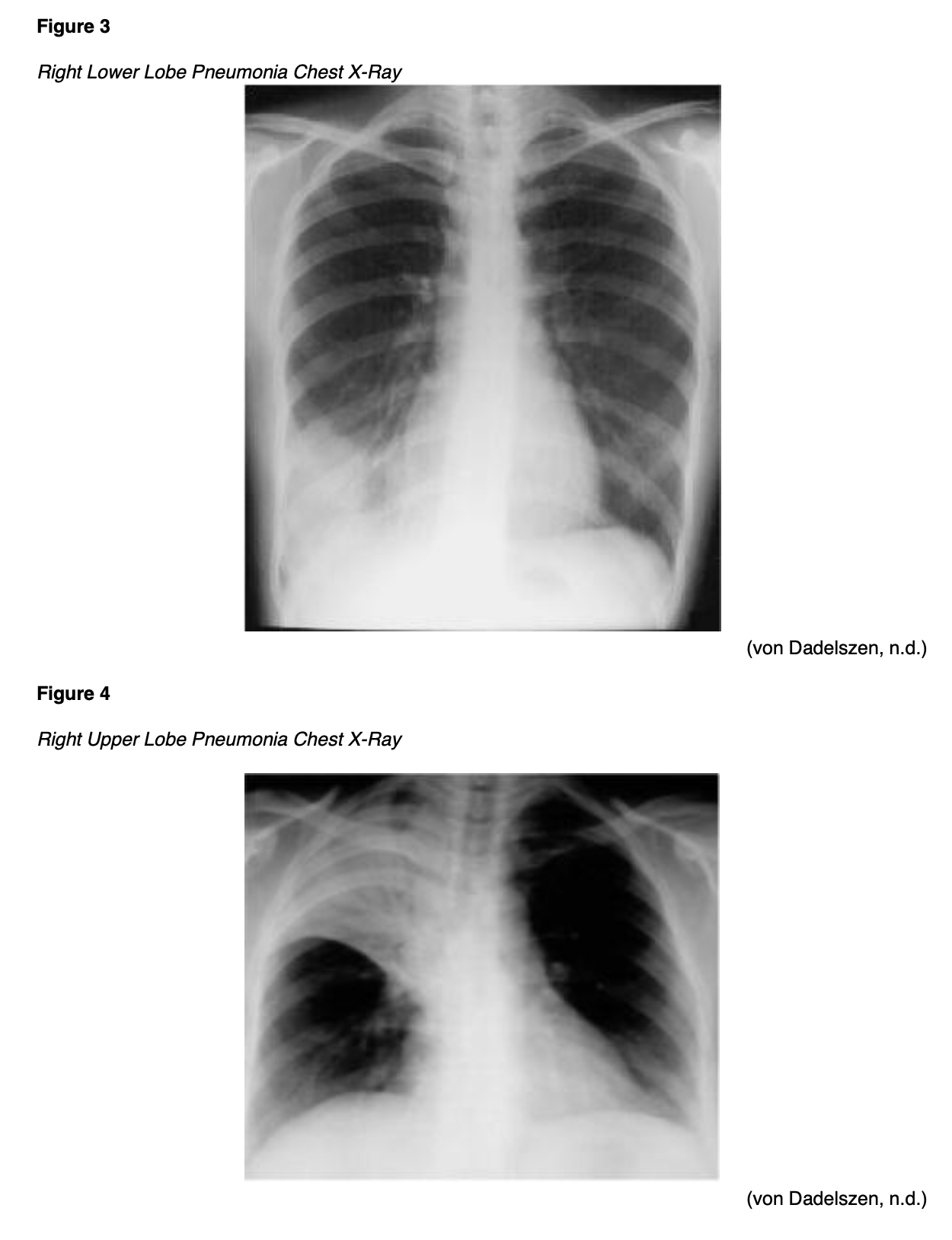 Lobar Pneumonia In Children