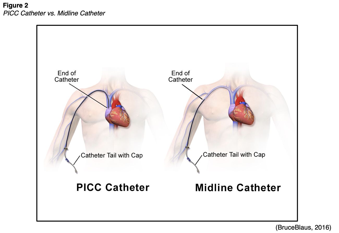 Vascular Access Devices Part 1 Nursing CE Course NursingCE