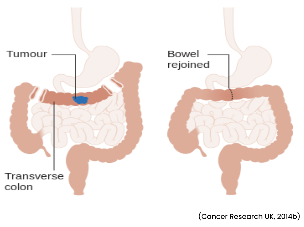 Ostomy Placement and Care Nursing CE Course NursingCE