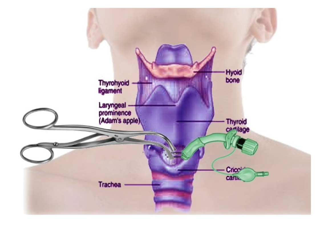 Tracheostomy Placement and Care Nursing CE Course NursingCE