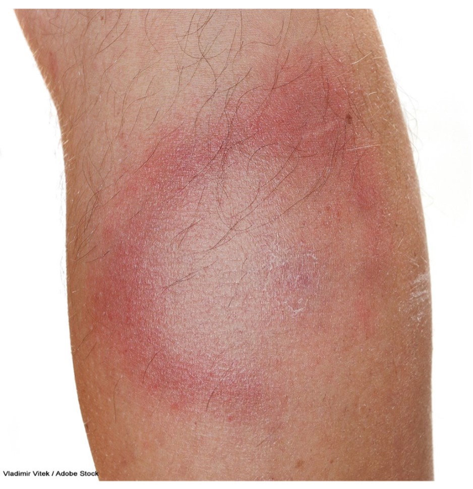 Tickborne Diseases Nursing CE Course for RNs and LPNs | NursingCE