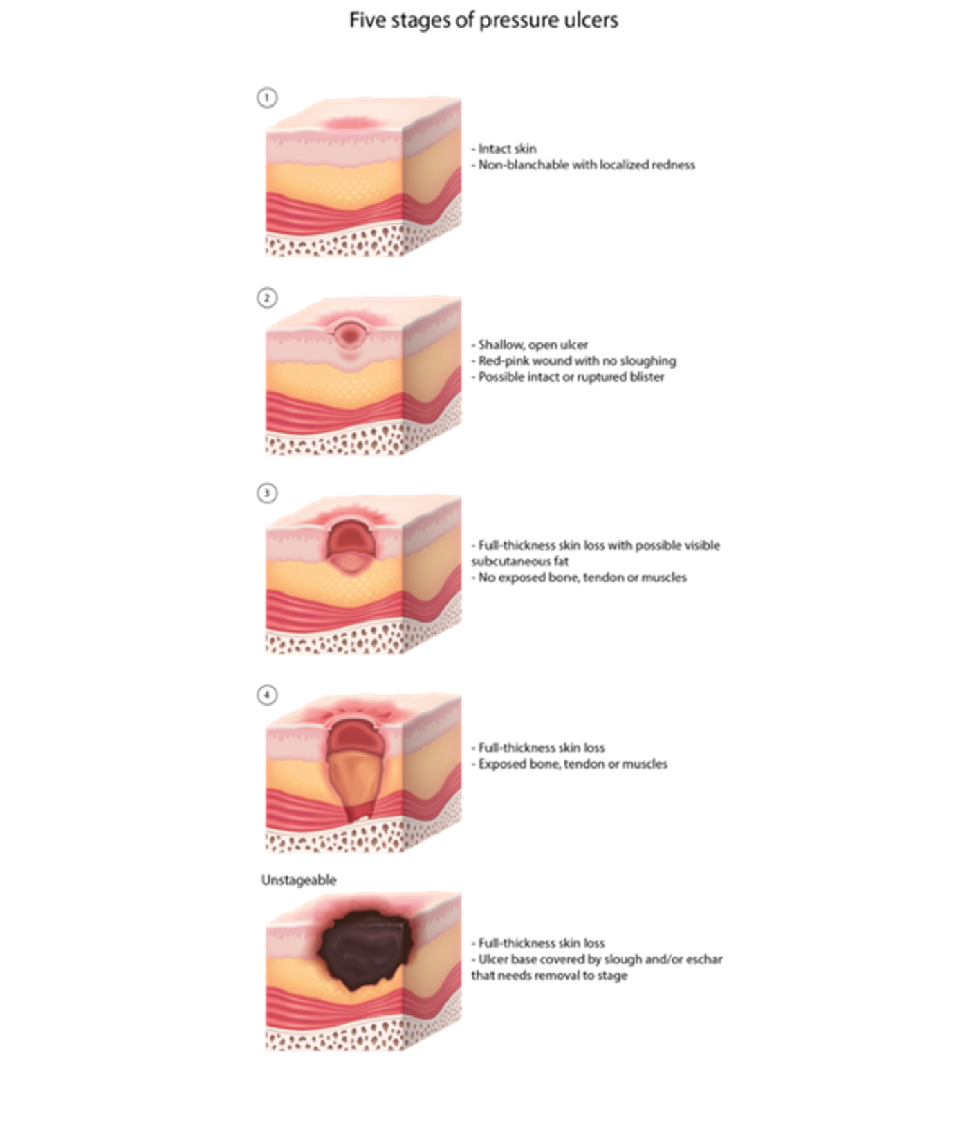 Pressure Injuries Nursing CE Course NursingCE