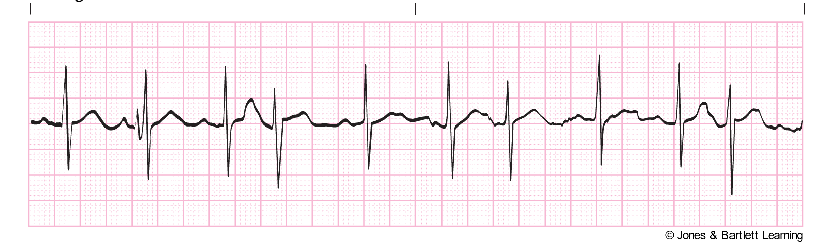 Introduction to Telemetry Monitoring for Arrhythmias Nursing CE Course ...