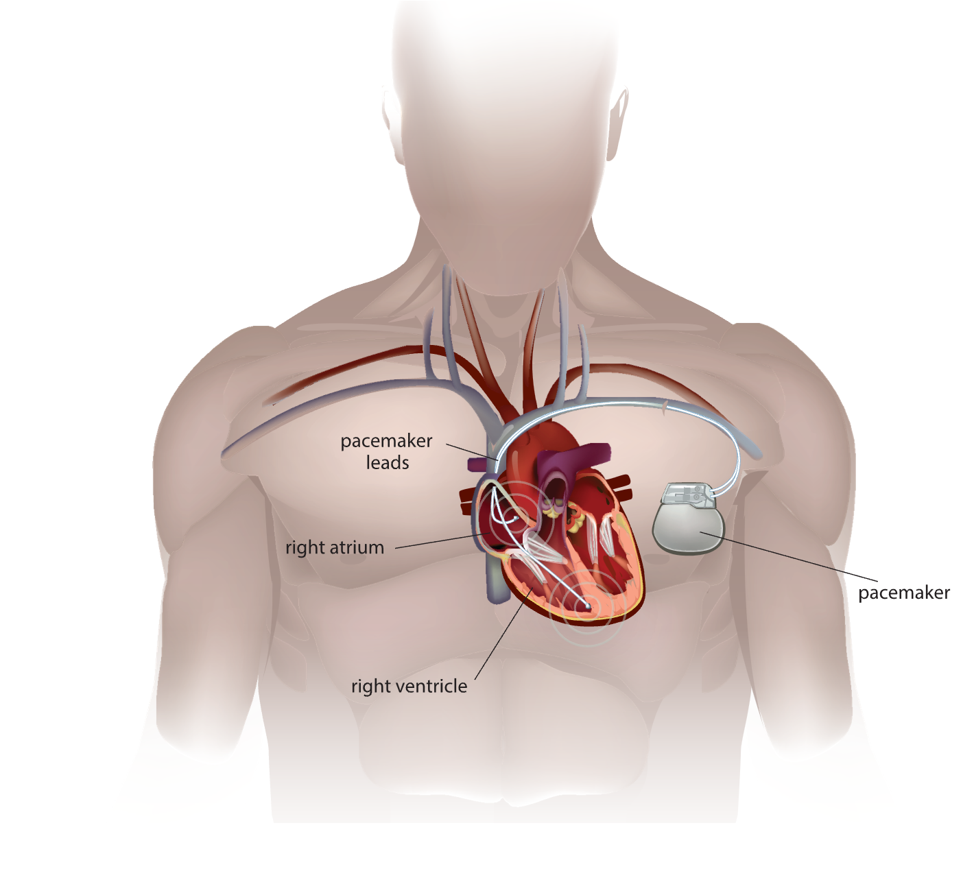 Introduction to Telemetry Monitoring for Arrhythmias Nursing CE Course ...