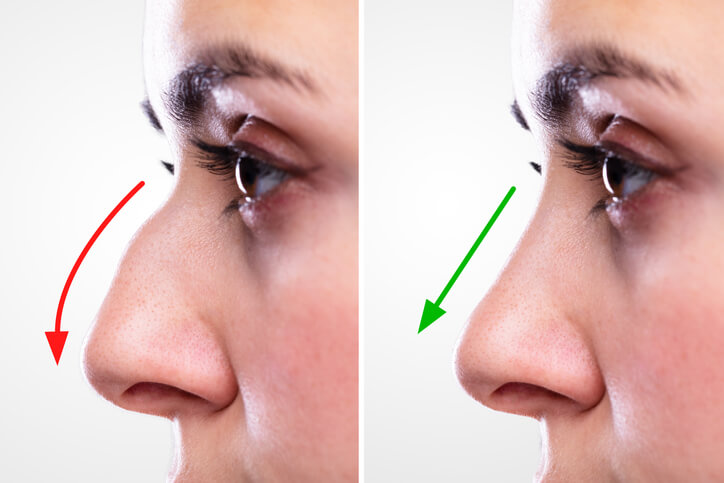  Non-Surgical Rhinoplasty Kurraba Point