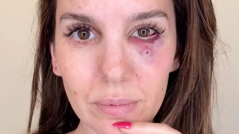 Christy Carlson Romano's Candid Account of Being Shot in the Face