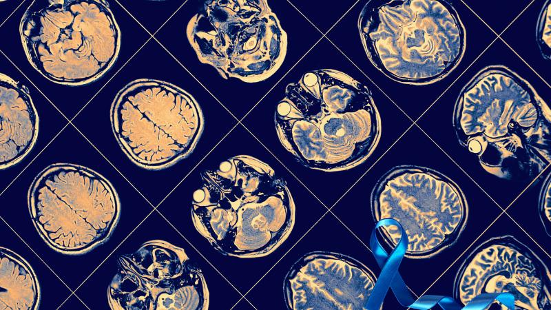 Suburban Mom Shares Glioblastoma Journey During Brain Cancer Awareness Month