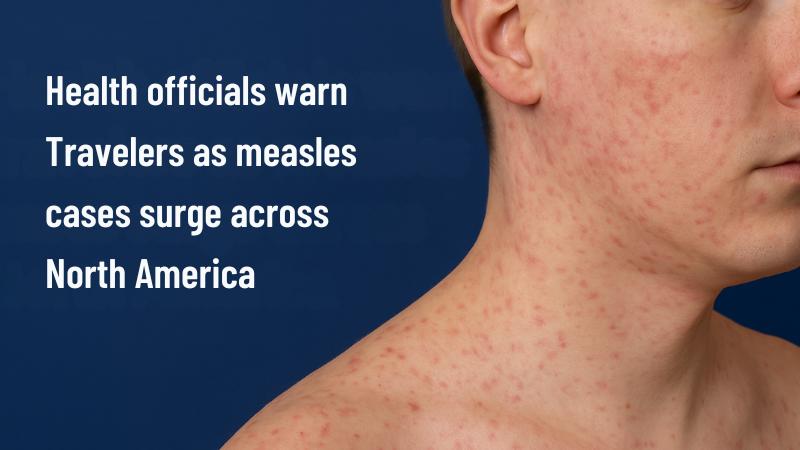 Health officials warn travelers as measles cases surge across North America