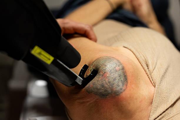 Tattoo Removal Laser adoption in cosmetic dermatology settings clinics