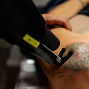 Tattoo Removal Laser adoption in cosmetic dermatology settings clinics