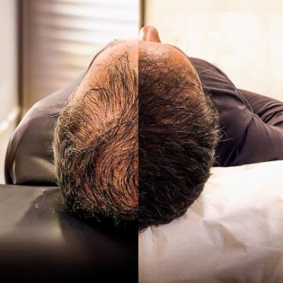 Natural Hair Restoration with Hair Transplant in Islamabad