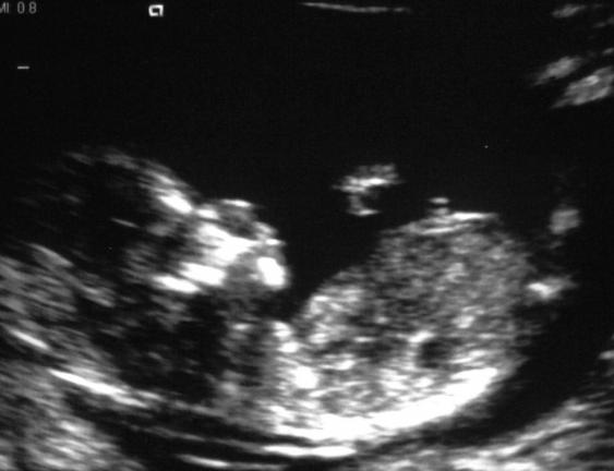 SUBMITTED PHOTO Ultrasound sonogram of a 13-week-old fetus. House Bill 1077 would require a woman to undergo a sonogram, and while receiving it, view the screen, and sign a statement to that effect before an abortion.
