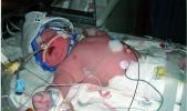 Hours after his birth in 2010, Bobby Edmonds of MaryD wears a Cool Cap in the NICU at the Janet Weis Children's Hospital at Geisinger Medical Center, Danville. The specialized pediatric device uses cool water to prevent swelling of the brain in an…