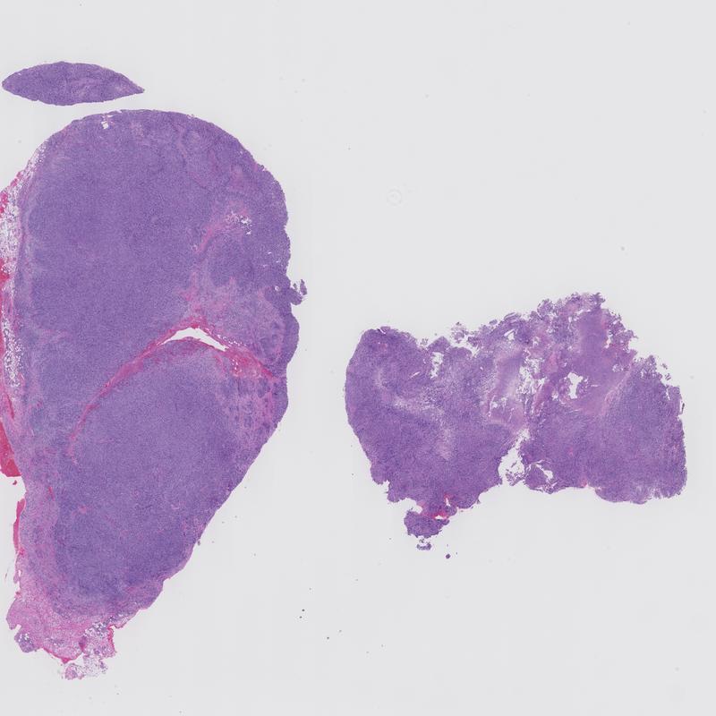 Spindle cell melanoma KiKo XP