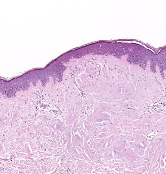 What s in your differential diagnosis of normal skin and what is the