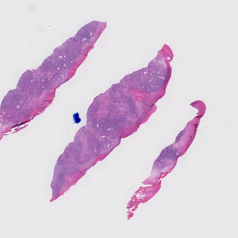 Kaposi with hyaline/eosinophilic globules/inclusions ("Dorf