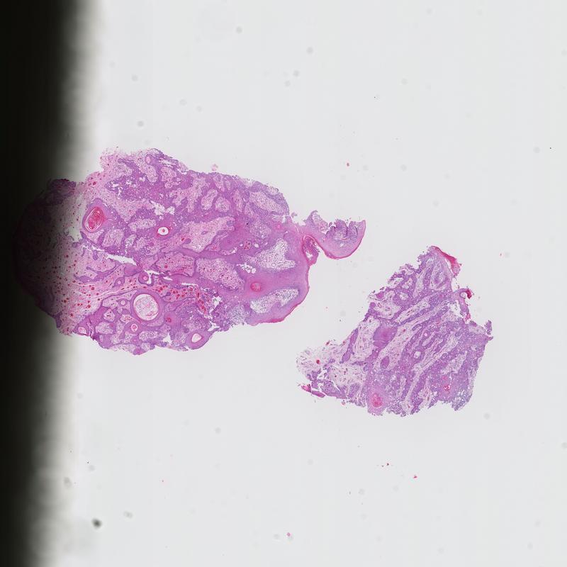 Secondary extramammary Paget disease from rectal adenocarcinoma