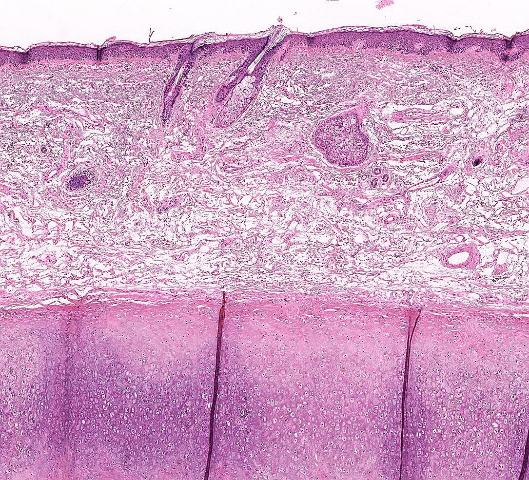 Let s Do A Little Basic Dermpath Series Where Is This Biopsy From Be