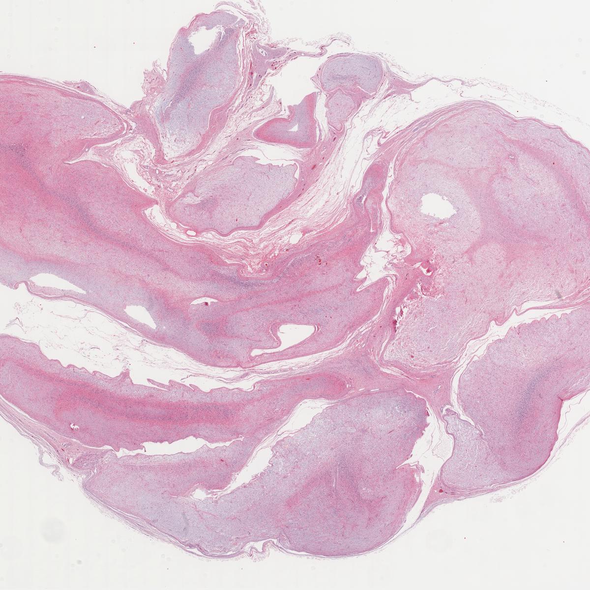 Deep soft tissue mass. Diagnosis? KiKo XP