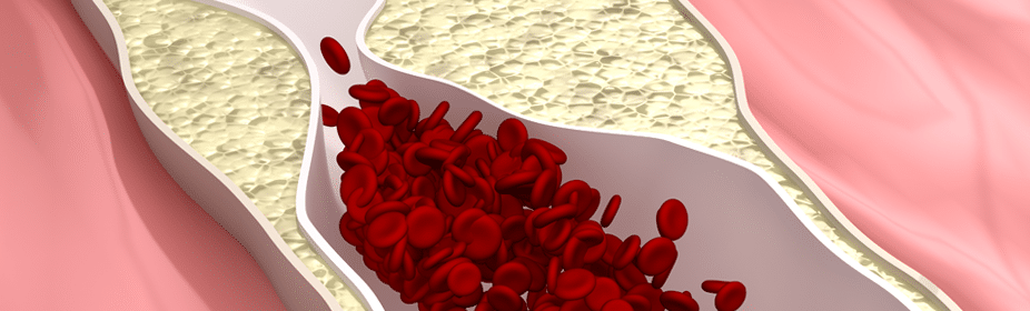 High Cholesterol? Consider Cholesterol Lowering Diet ...