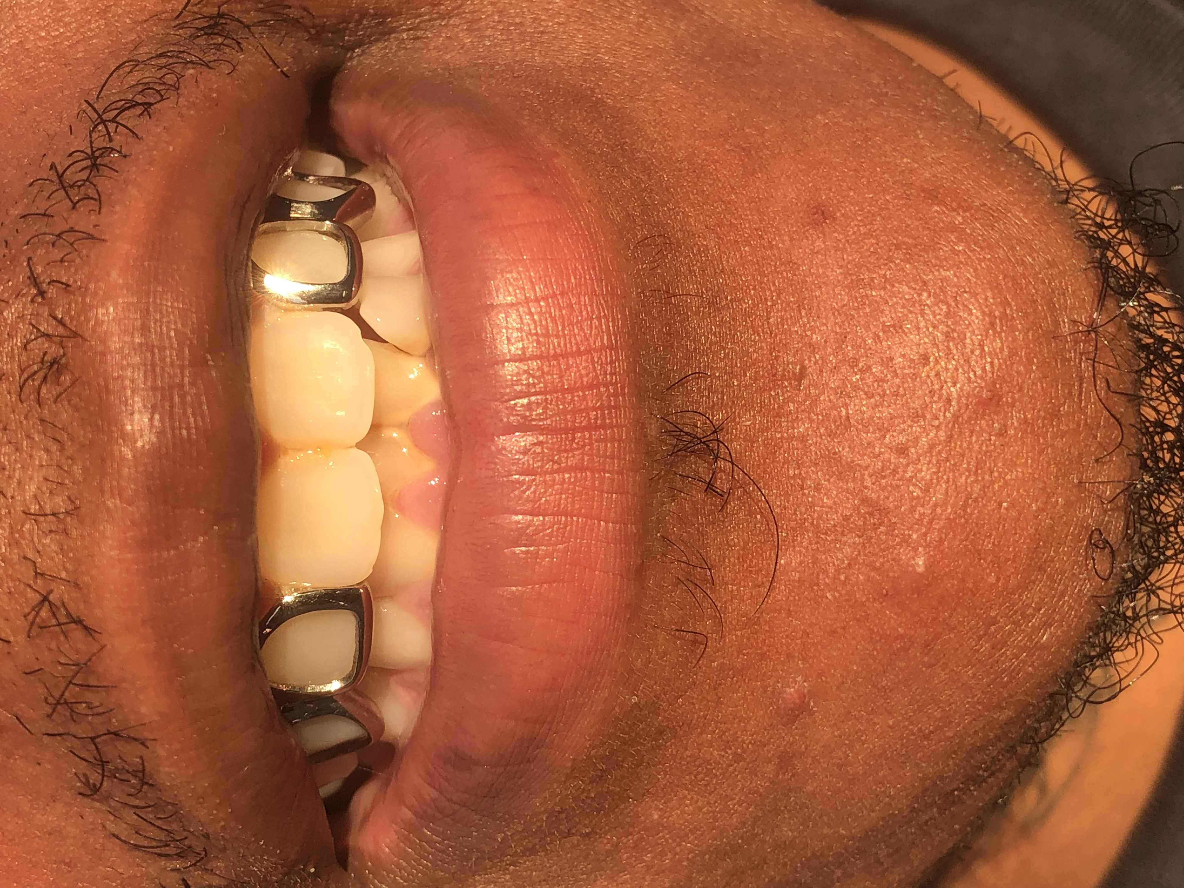 Heru grillz : Diamond gold teeth Image