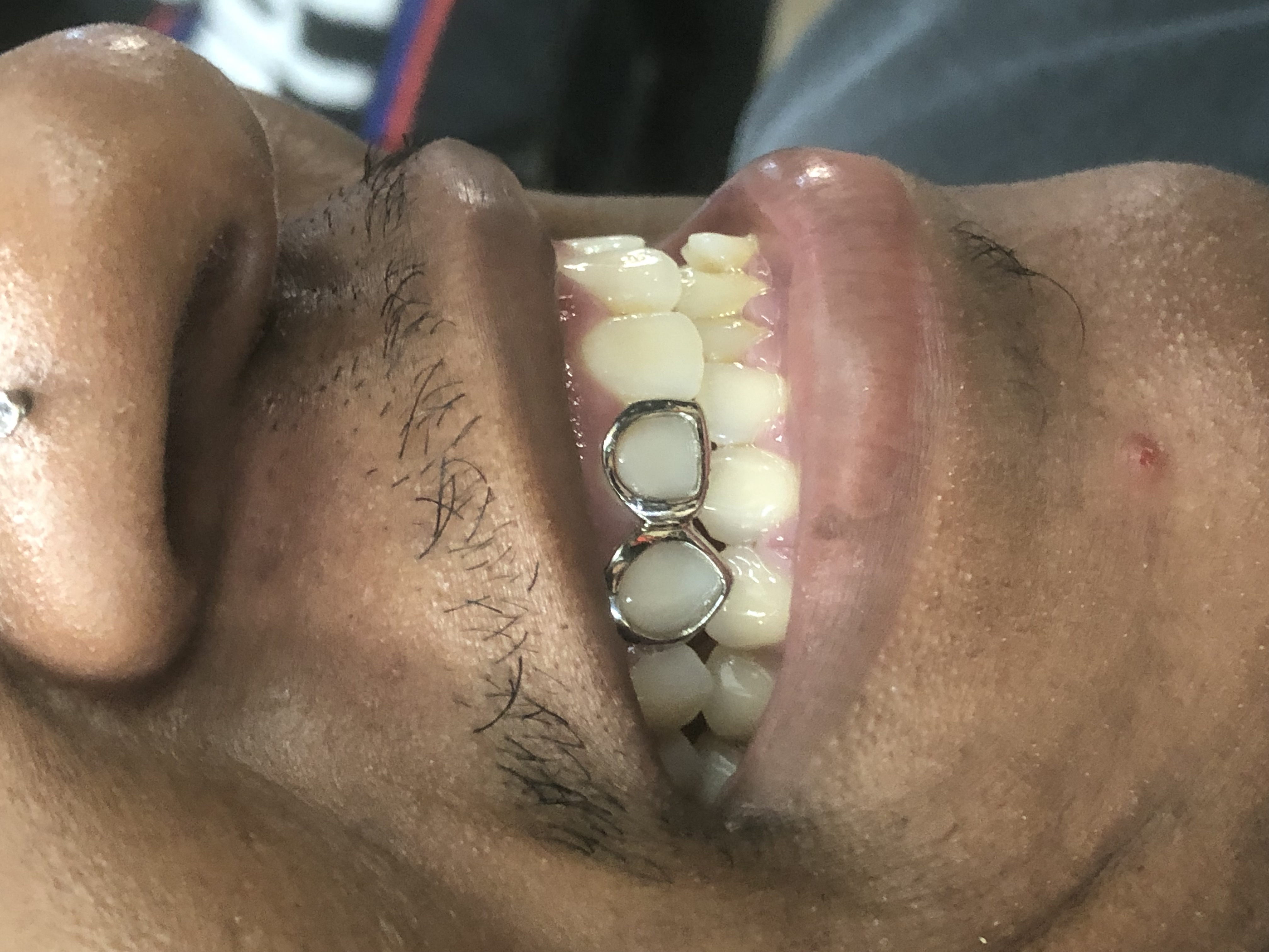 Heru grillz : Diamond gold teeth Image