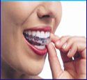 If you are looking for Invsialign clear braces then this link to find out everything you need to know about nvsialign clear braces at Eternal Smiles. Don't wait click here now to find out more. If you are looking for Invsialign clear braces then this link to find out everything you need to know about nvsialign clear braces at Eternal Smiles. Don't wait click here now to find out more.