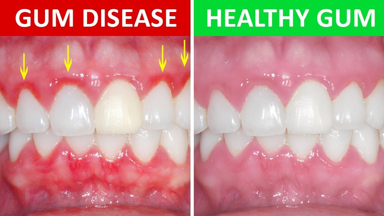 periodontitis treatment "receding gums" periodontitis treatment what's gum disease "gums bleeding" "painful gum" "gum cleaning cost" "most effective treatment gum disease" "receding gums laser treatment birmingham" "if molars teeth moving and hurting" periodontal treatment bleeding gums treatment "what is gum disease" "how to cure gum disease" abscess on gum cure for gingivitis gum disease "teeth bleeding" "gum care" "gum problem" "how to treat gums" "my teeth are wobbly due to peridontal disease" "gum disease treatment places in birmingham" "my gums come away from my teeth" "periodontist birmingham uk" periodontal disease "periodontal" "gum disease treatment cost" "laser gum disease treatment" "gum clinic near me" "gums is really hurting" "pain and inflammation in gums" periodontal disease treatment "gum disease" "gum disease treatment" "gum treatment" gum disease dentist "periodontal laser treatment" "gum pain" "teeth and gums hurt" "laser dentist birmingham" "periodontitis of the gums" "pyhyorrhea" periodontitis advanced periodontal disease "bleeding gums" gum abscess "treatment of gum disease" "periodontal treatment cost" "laser gum surgery" deep clean teeth "gum clinic" "gum problems" "laser gum cleaning birmingham uk" "lazer treatment for receding gum westmidlands" periodontal gum disease periodontal dentist "how to treat gum disease" "deep teeth cleaning cost" "severe gum disease" "how to get healthy gums" "how to help sore gums" "how to remove gum disease" "i have severe gum disease" "options if you have loose teeth and gum disease" periodontitis treatment "receding gums" periodontitis treatment what's gum disease "gums bleeding" "painful gum" "gum cleaning cost" "most effective treatment gum disease" "receding gums laser treatment birmingham" "if molars teeth moving and hurting" periodontal treatment bleeding gums treatment "what is gum disease" "how to cure gum disease" abscess on gum cure for gingivitis gum disease "teeth bleeding" "gum care" "gum problem" "how to treat gums" "my teeth are wobbly due to peridontal disease" "gum disease treatment places in birmingham" "my gums come away from my teeth" "periodontist birmingham uk" periodontal disease "periodontal" "gum disease treatment cost" "laser gum disease treatment" "gum clinic near me" "gums is really hurting" "pain and inflammation in gums" periodontal disease treatment "gum disease" "gum disease treatment" "gum treatment" gum disease dentist "periodontal laser treatment" "gum pain" "teeth and gums hurt" "laser dentist birmingham" "periodontitis of the gums" "pyhyorrhea" periodontitis advanced periodontal disease "bleeding gums" gum abscess "treatment of gum disease" "periodontal treatment cost" "laser gum surgery" deep clean teeth "gum clinic" "gum problems" "laser gum cleaning birmingham uk" "lazer treatment for receding gum westmidlands" periodontal gum disease periodontal dentist "how to treat gum disease" "deep teeth cleaning cost" "severe gum disease" "how to get healthy gums" "how to help sore gums" "how to remove gum disease" "i have severe gum disease" "options if you have loose teeth and gum disease"