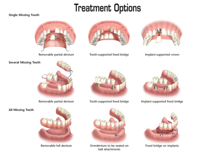 22 Several Before and And After Dental Implants, best place to get implants, best dentist for implants, dentist specializing in implants