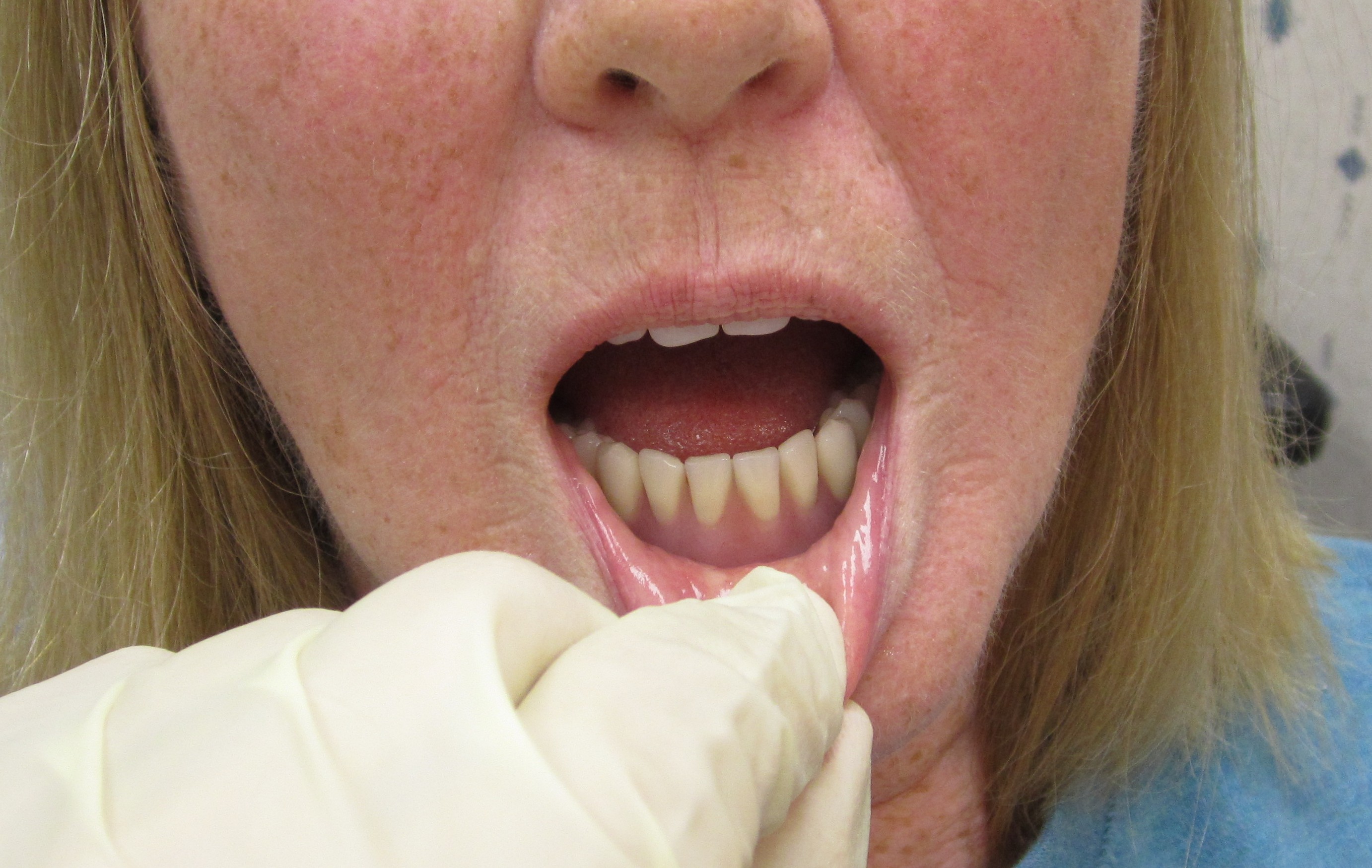 3 denture implants 3 denture implants