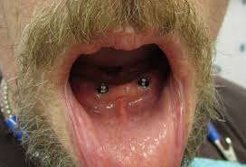 4 denture implants 4 denture implants
