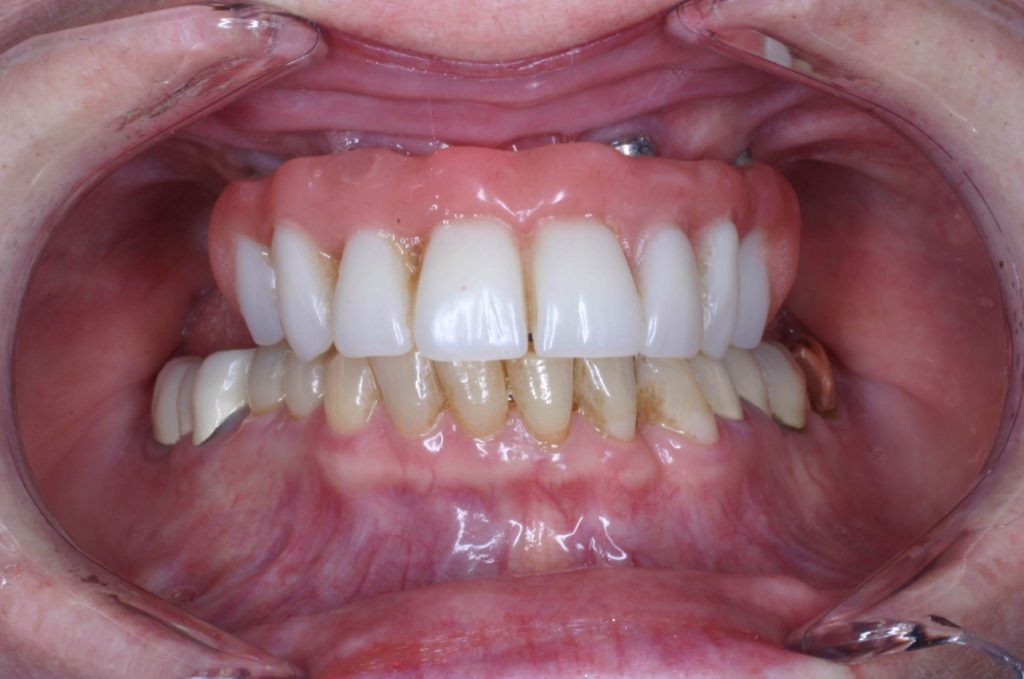7 denture implants 7 denture implants