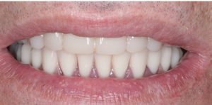 9 denture implants 9 denture implants