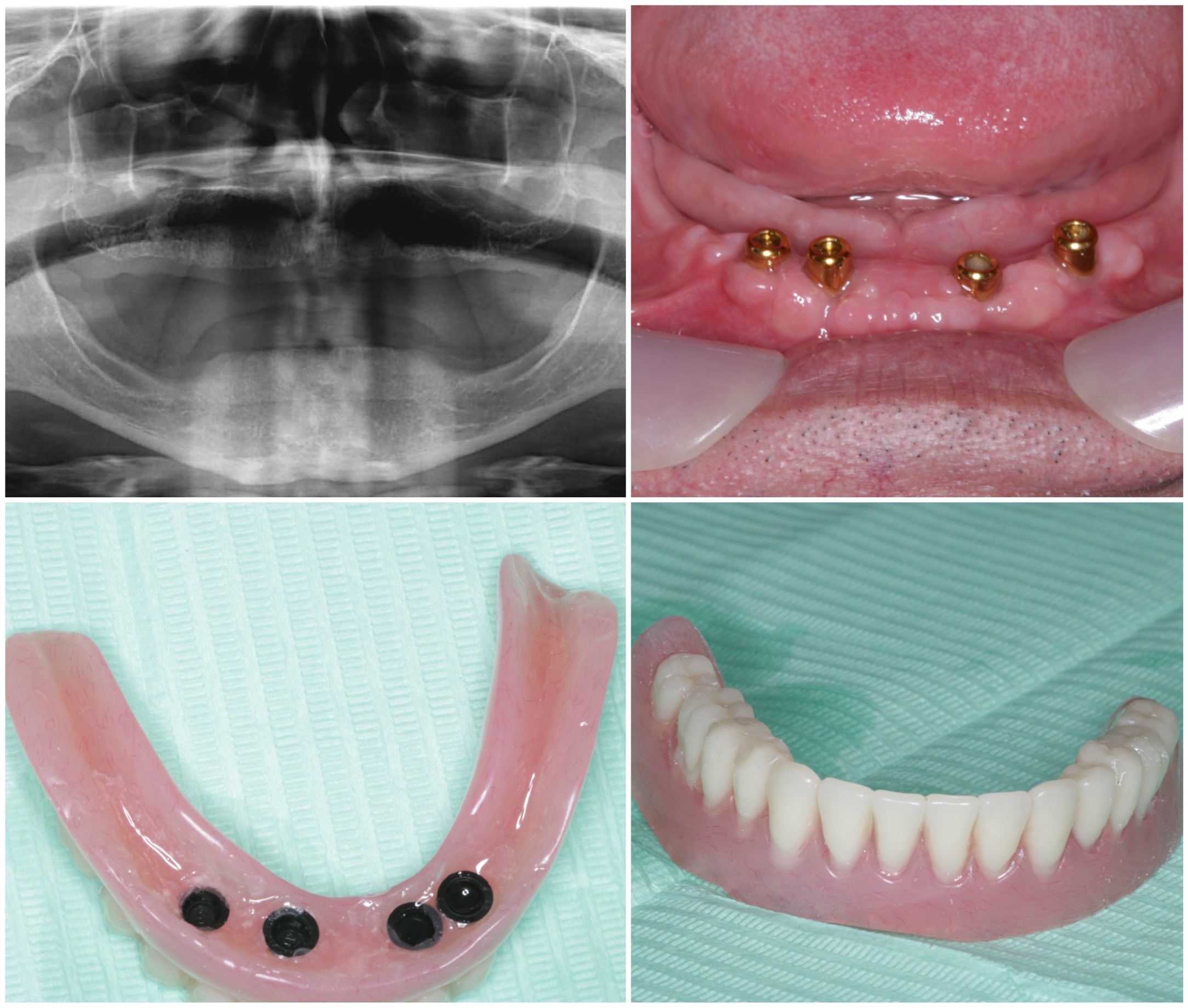 9a denture implants 9a denture implants