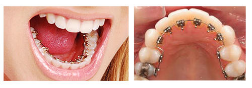 2 lingual-braces-500x500 2 lingual-braces-500x500