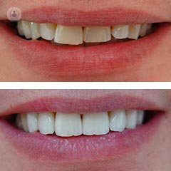 11 before-and-after 11 before-and-after