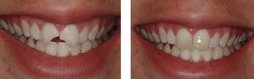 4 before-and-after 4 before-and-after