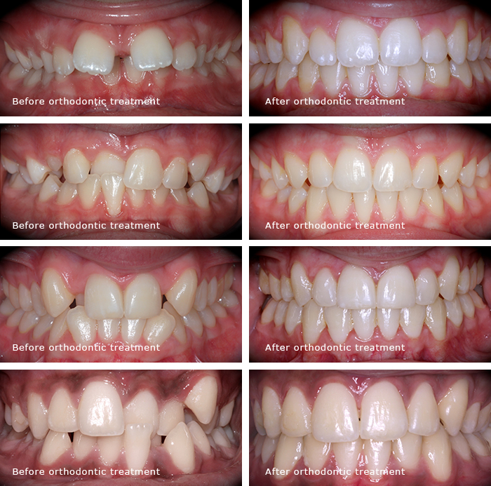 Best dentist, braces, implants, cosmetic dentist, best veneers dentist, implant, emergency dentist, veneers, smile makeovers before-after copy Best dentist, braces, implants, cosmetic dentist, best veneers dentist, implants