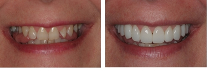 smile makeover veneers, dental veneers, porcelain veneers, lumineers, composite bonding, bonding veneers