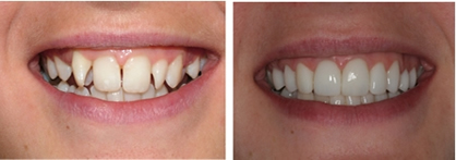 smile makeover 3 veneers, dental veneers, porcelain veneers, lumineers, composite bonding, bonding veneers