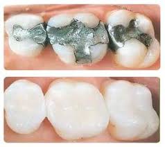 amalgam free silver free safely removed and replaced with safe BPA free and Fluoride Free Fillings amalgam free silver free safely removed and replaced with safe BPA free and Fluoride Free Fillings