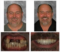 multiple implants multiple implants