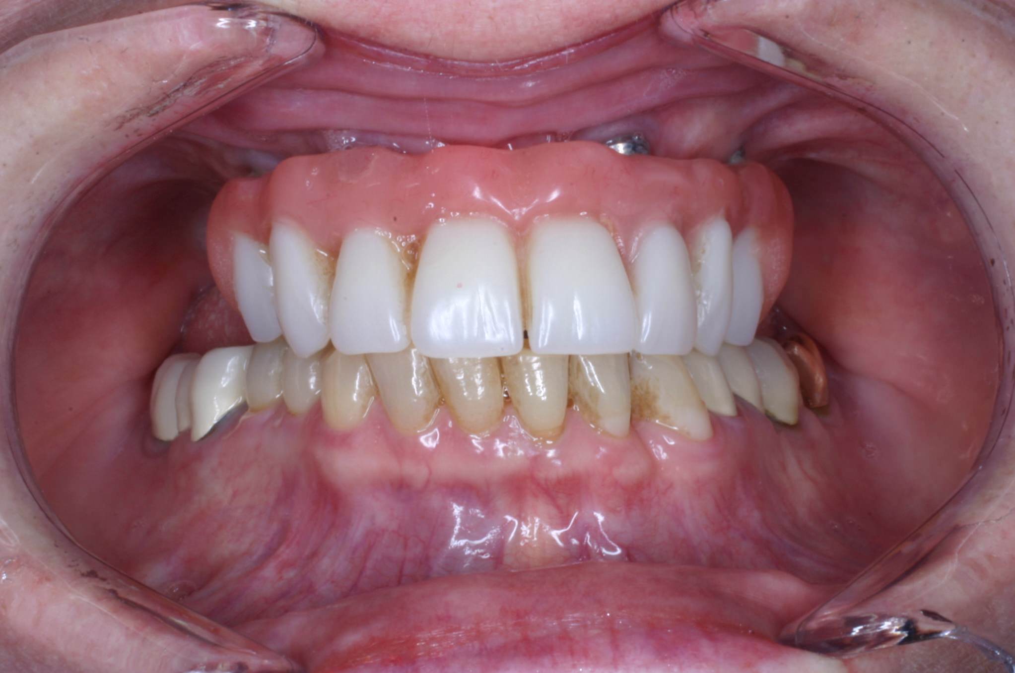 7-denture-implants dentures over implants dentures on implants dental denture implants dental implants with dentures false teeth screwed into jaw permanent false teeth implants "implant false teeth" denture implans denture stabilization implants dentures and implants false teeth implants implant dentures dental replace dentures with implants dental implants or dentures "implants for dentures" "permanent denture implants" dental implants and dentures implants or dentures denture dental implants implant dentures dentures screwed into jaw dental implants dentures dental implants for dentures dentures implants options implants and dentures false teeth or implants i have dentures can i get implants implants instead of dentures "denture implants procedure" are implants better than dentures dentures with implants implants with dentures "denture implants" dental implants instead of dentures dentures attached to implants "cost for denture implants" dentures or implants permanent implant dentures "new dental implants" "all teeth implants" "Dental implants birmingham" implant dentist birmingham "dental implants birmingham uk" "best implant dentist" "the best dental implants" "dental implants solihull" "Dental implants birmingham" "dental implant options" dentist specializing in implants "new teeth implants" implant teeth "Dental implant cost" "dental implants solihull" "dental implant center" "oral implants" "dental implant treatment" new teeth implants "tooth implant price" dental implants birmingham "best place for dental implants" dentist that specializes in implants "dentist specializing in implants" "Teeth implants" "best dental implants" "implant price" "Implant dentistry" "center for dental implants" "replace teeth with implants" best place to get teeth implants "Denture implants" "cosmetic dental implants" "top dental implants" cosmetic teeth implants "implants birmingham" "local dental implants" "implant teeth" "best place to get dental implants" "best place for dental implants" "affordable dental implants" "price of dental implants" Birmingham dentist implants "dental implants in birmingham" "best place to get dental implants" "latest dental implants" "the best dental implants" cosmetic implant dentistry "implants for teeth" "cosmetic teeth implants" best dentist for implants "dental implant knowle" "cosmetic and implant dentistry" "dental implant cost" "dental implants west midlands" "best dentist for implants" all teeth implants "the best implant dentist" "best place to get teeth implants" "cosmetic implant dentistry" "center for implant dentistry" "dentist that specializes in implants" "best implants for teeth"