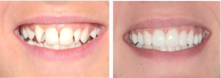 smile makeovers with emax veneers and crowns 1 smile makeover
dental makeover
teeth makeover
cosmetic dentistry smile makeover
mouth makeover
veneers smile makeover
cosmetic smile makeover
smile makeover dentist
best smile makeover dentist
full smile makeover
smile makeover options
one day smile makeover
cosmetic dentistry options
cosmetic dental makeover
complete smile makeover
smile dental care
complete teeth makeover
extreme smile makeover
veneer makeover
one day dental makeover
full dental makeover
full mouth makeover
