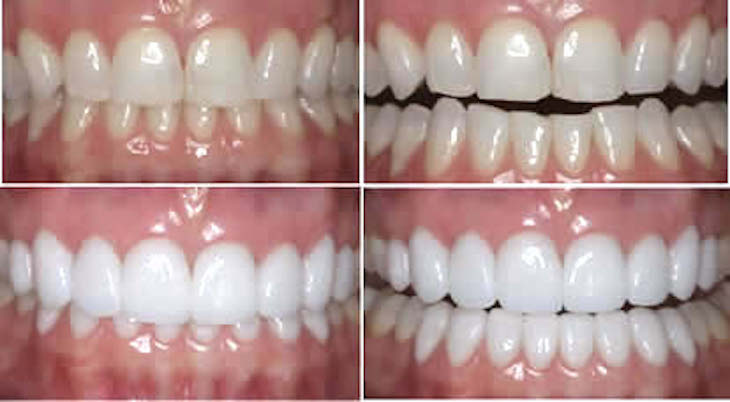veneers emax lumineers dental makeover teeth makeover cosmetic dentistry smile makeover mouth makeover veneers smile makeover cosmetic smile makeover smile makeover dentist best smile makeover dentist full smile makeover smile makeover options one day smile makeover cosmetic dentistry options