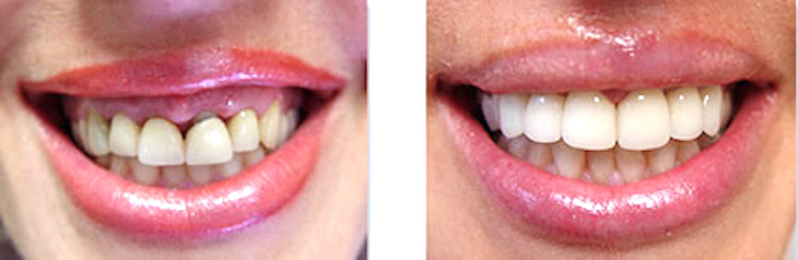lady with front 4 teeth veneers smile makeover
dental makeover